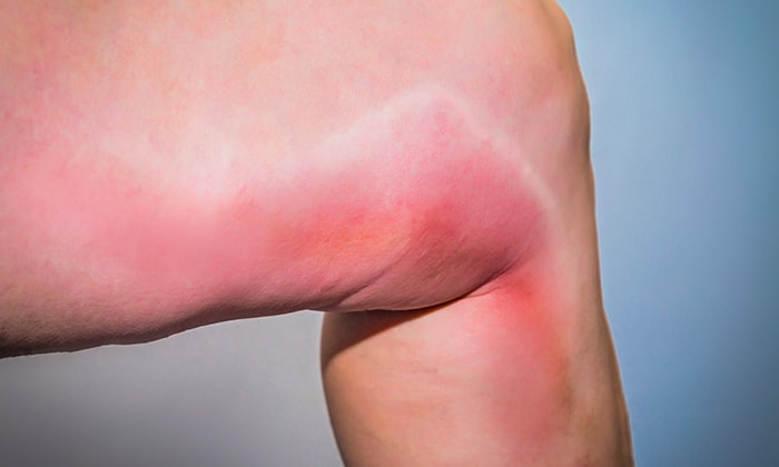 Флебит глубоких вен фото